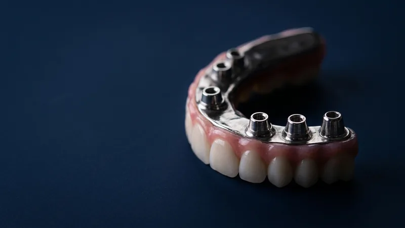 Prótese fixa sobre implantes